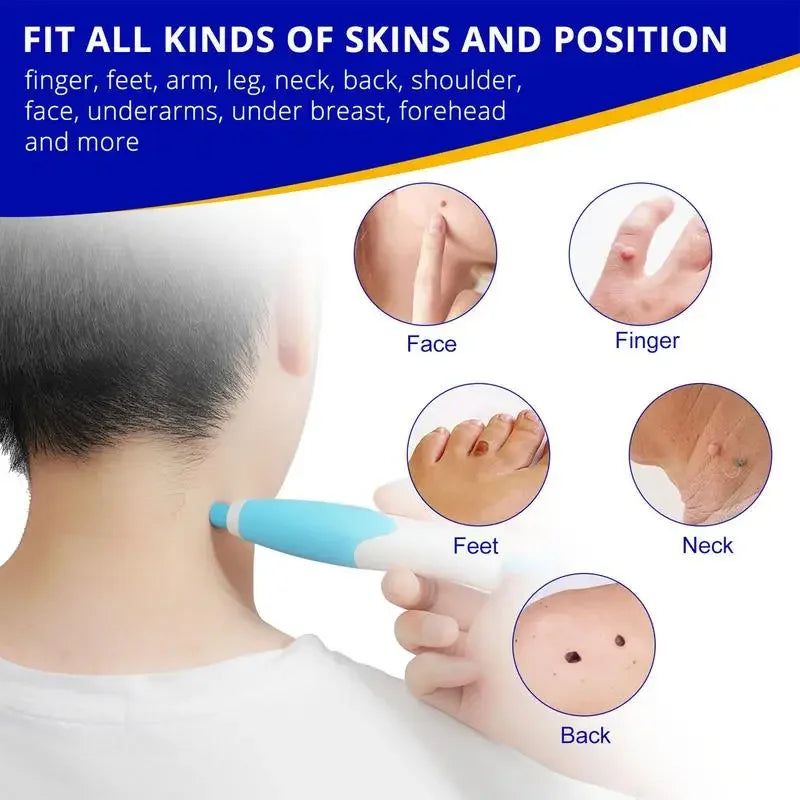 Wart remover kit