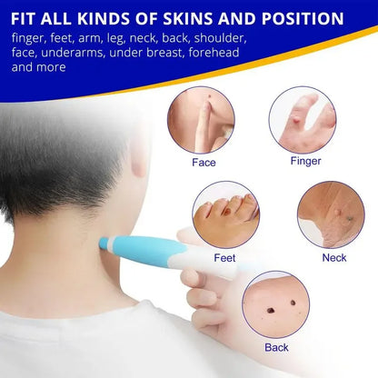 Wart remover kit